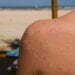 The Best Treatments for Sunburn, According to Dermatologists