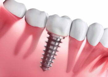 The Dental Implant Pros: More than a Pretty Face