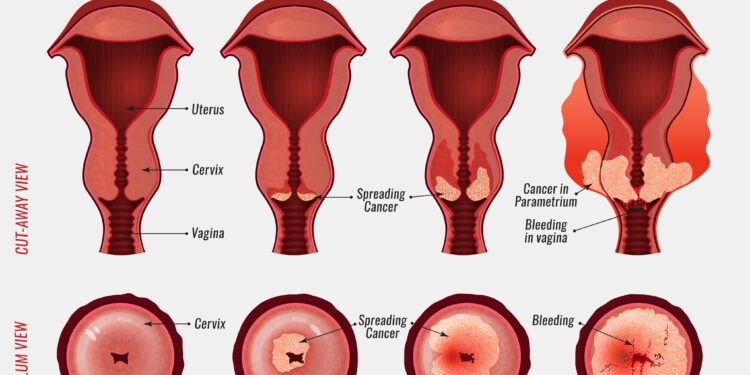 Cervical Cancer: What You Should Know