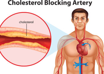 Cholesterol Levels and How to Deal with Them