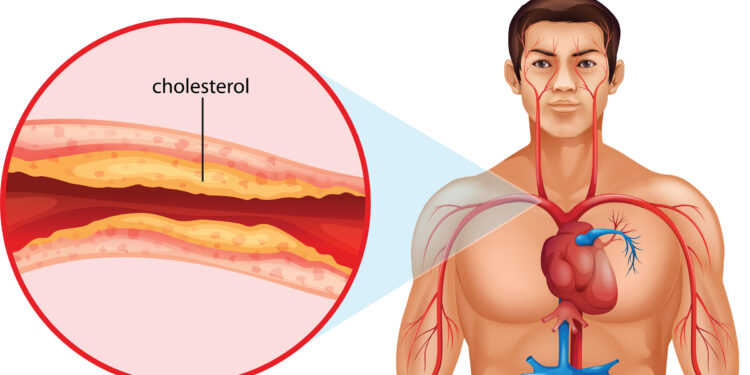 Cholesterol Levels and How to Deal with Them
