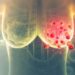 Nccn Guidelines For Breast Cancer Treatment